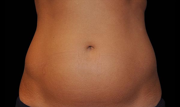 Before Photo of Skin Treatment