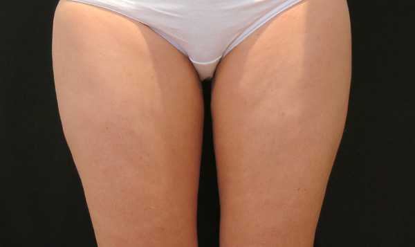 Academy Face and Body Vascular Laser Treatment After