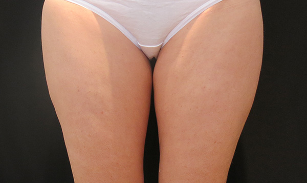 Before image of thighs before treatment.
