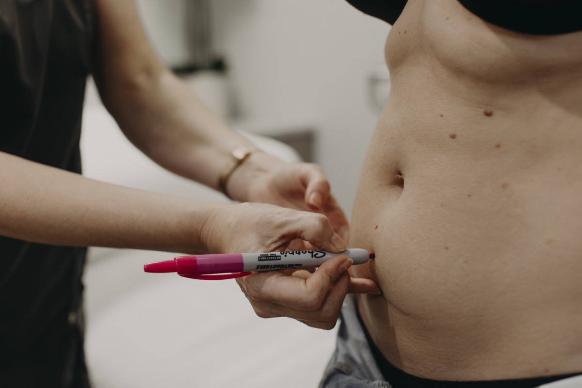 EM Lift Max treatment for facial contouring.