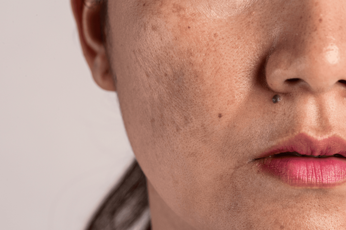 academy face and body Melasma