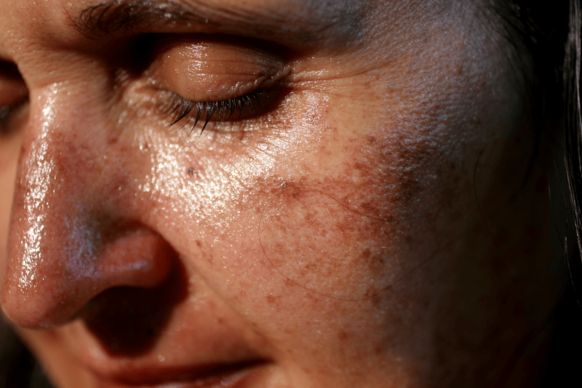 academy face and body Pigmentation