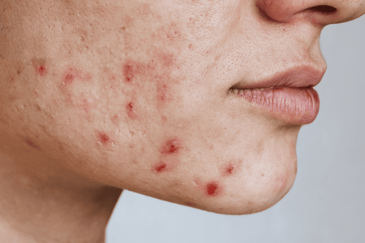 academy face and body acne