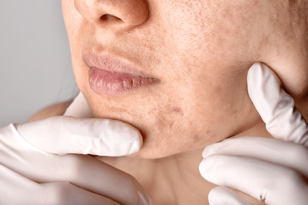 Academy Face and Body Scarring Perth