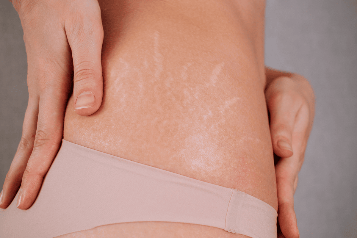 Effective stretch mark reduction treatments at Academy Face and Body