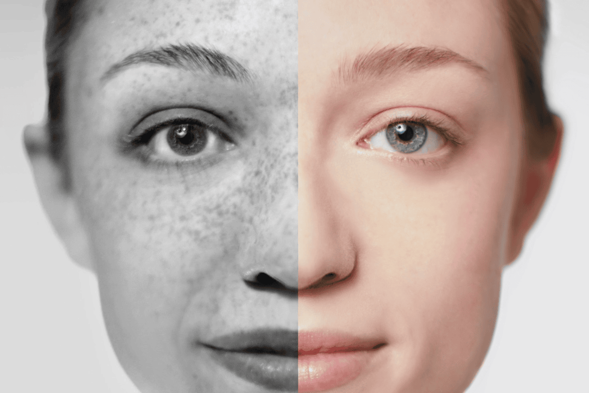 Sun damage treatment for improved skin texture.