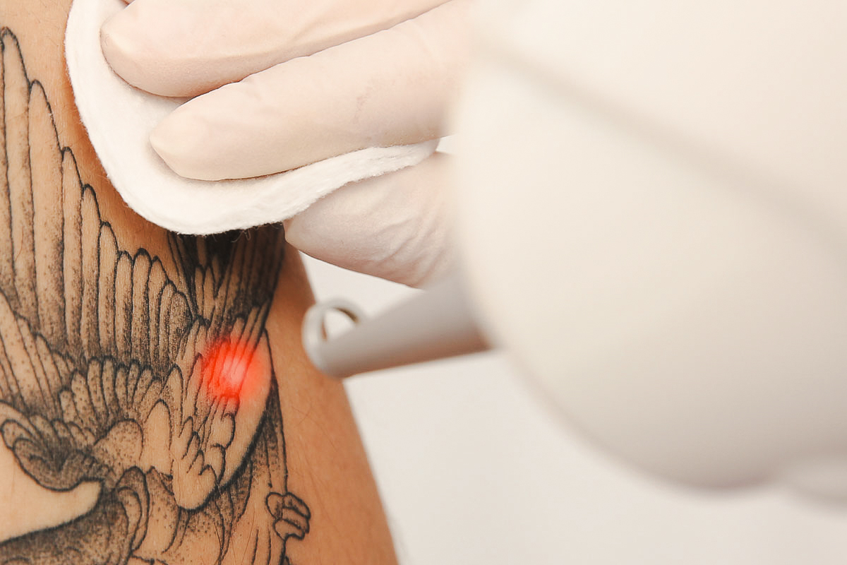 Laser Tattoo Removal Services