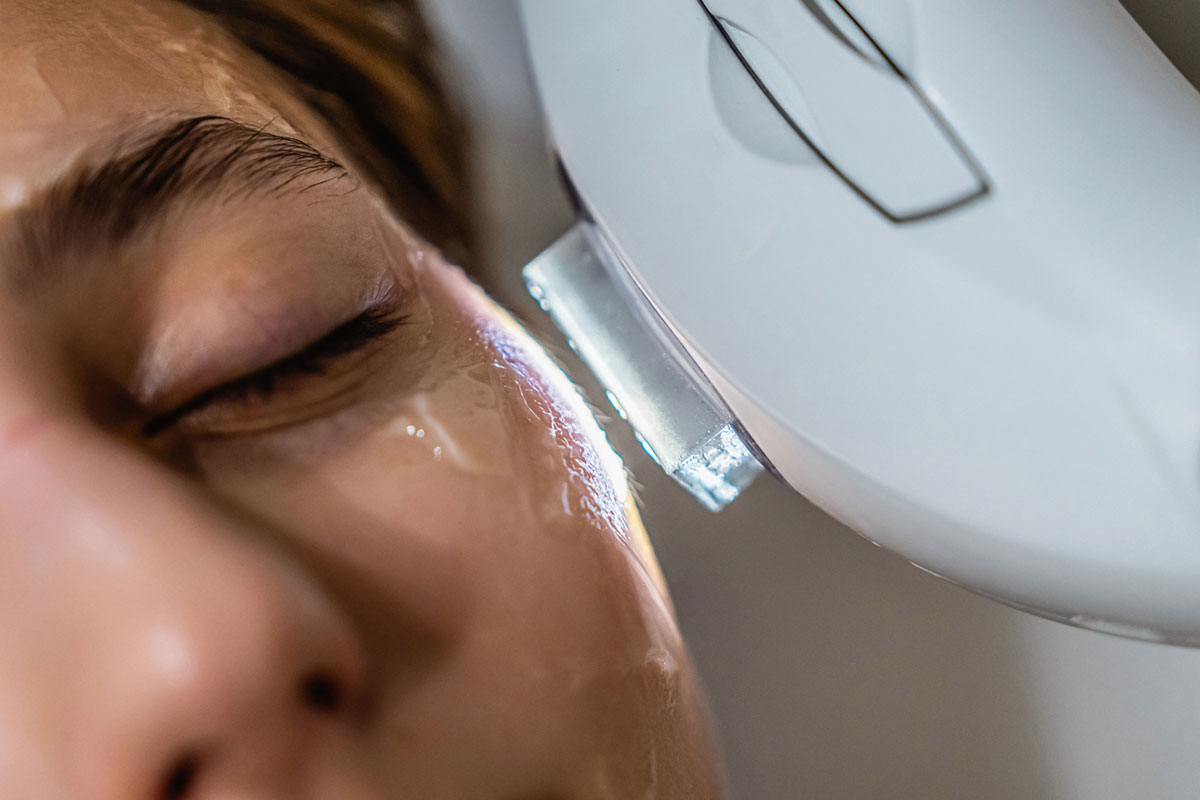 IPL skin rejuvenation treatment