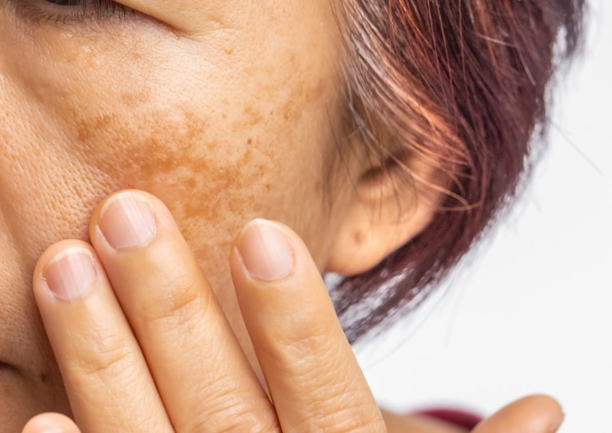 Laser Pigment Peel Treatment Image