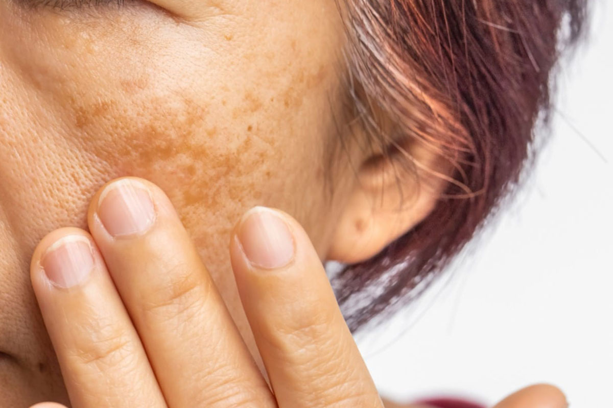 academy face and body laser pigment