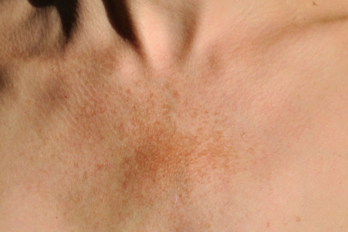 Laser pigmentation spot treatment in progress.